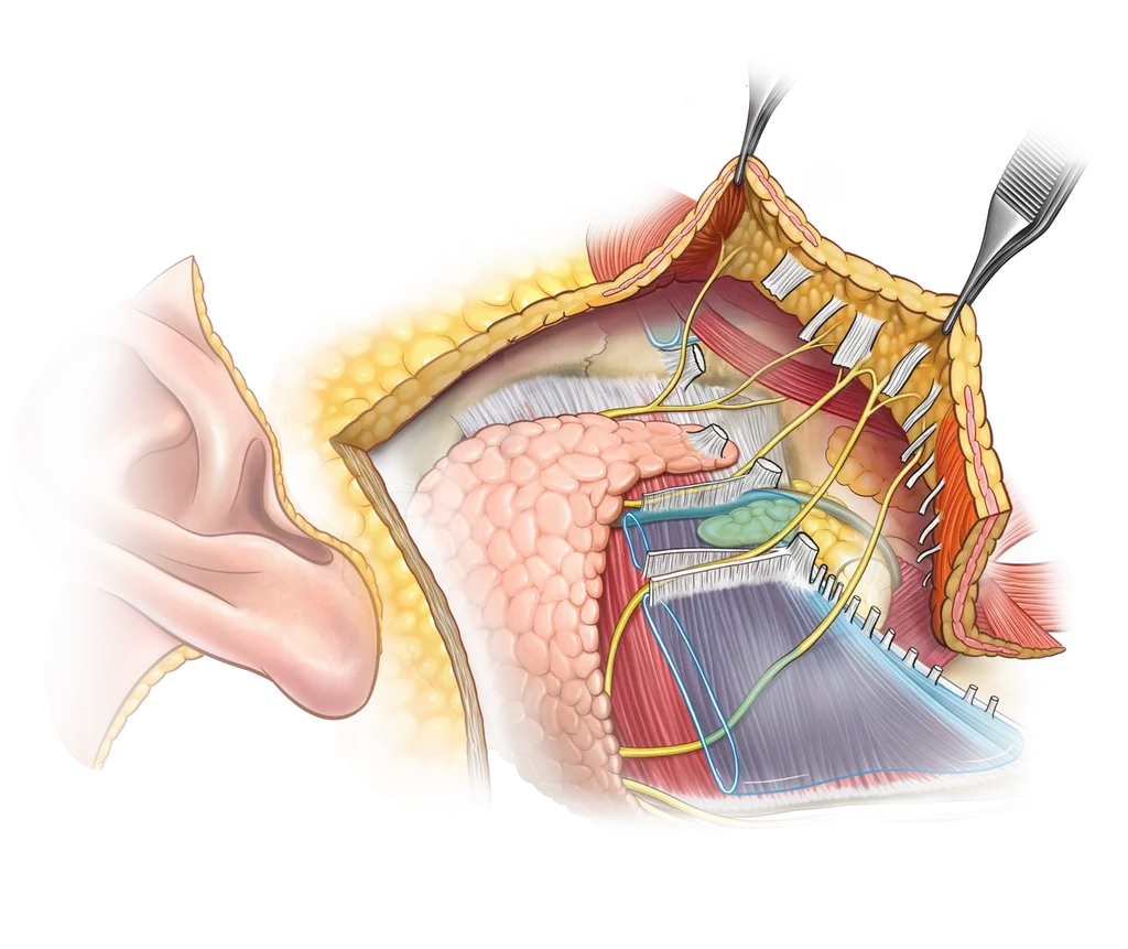 DEEP PLANE FACELIFT surgical illustration