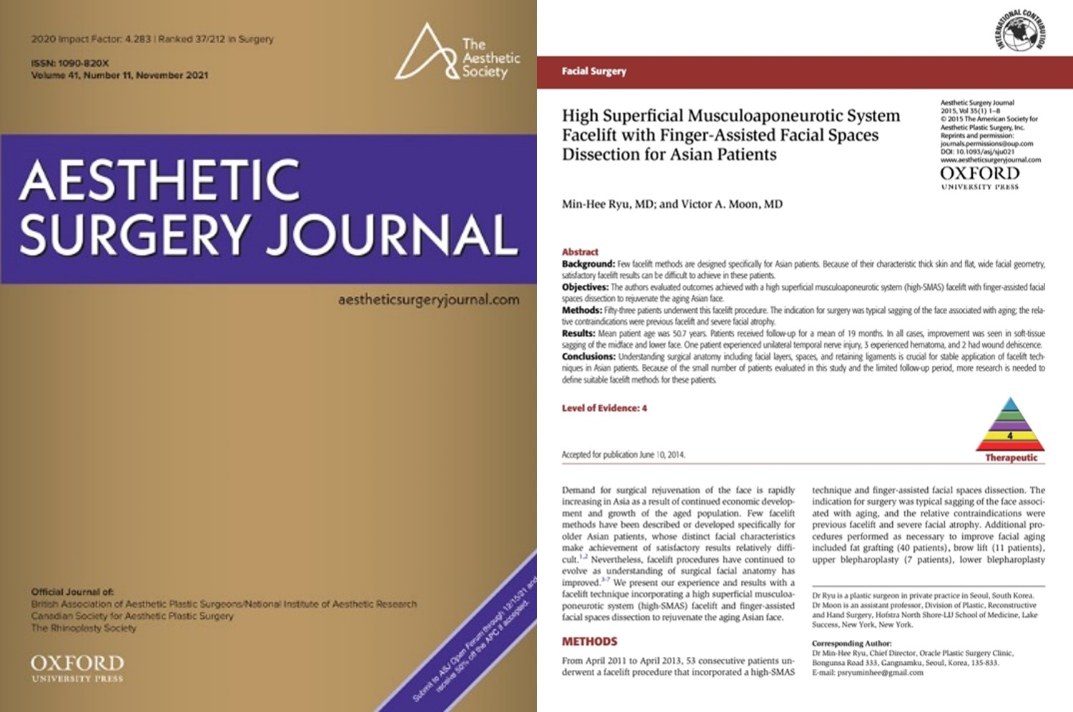 Aesthetic Surgery Journal 2015 &mdash; High Superficial Musculoaponeurotic System Facelift with Finger-Assisted Facial Spaces Dissection for Asian Patients, Min-Hee Ryu