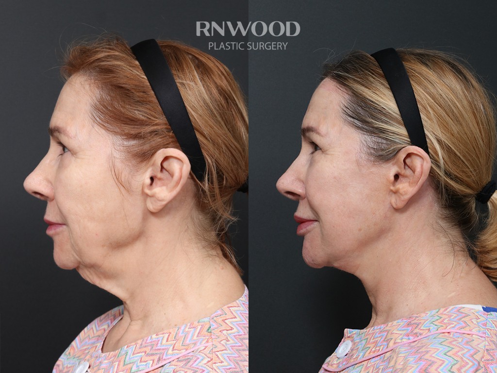 DEEP PLANE FACELIFT and Necklift, before and after, left profile view, case 01