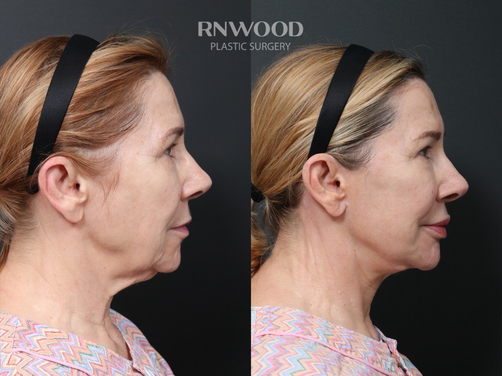 DEEP PLANE FACELIFT and Necklift, before and after, right profile view, case 01
