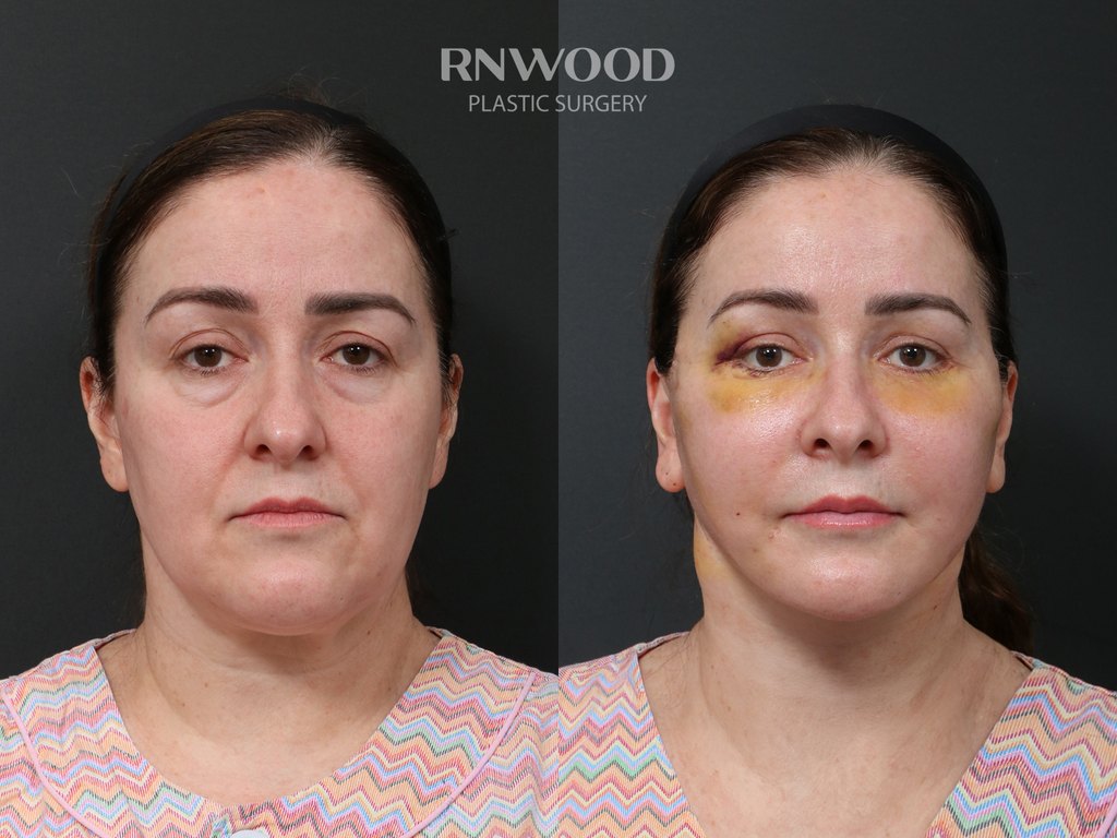 DEEP PLANE FACELIFT and Necklift, before and after, front view, case 02