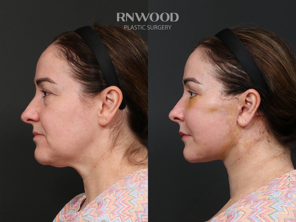 DEEP PLANE FACELIFT and Necklift, before and after, left profile view, case 02
