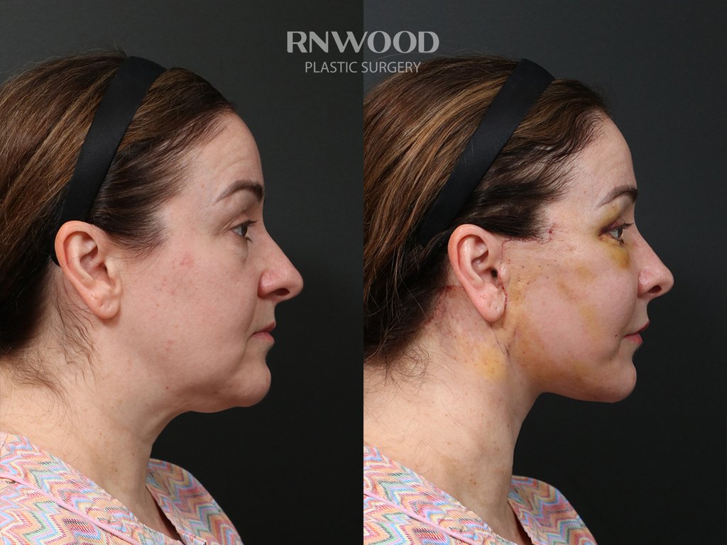 DEEP PLANE FACELIFT and Necklift, before and after, right profile view, case 02