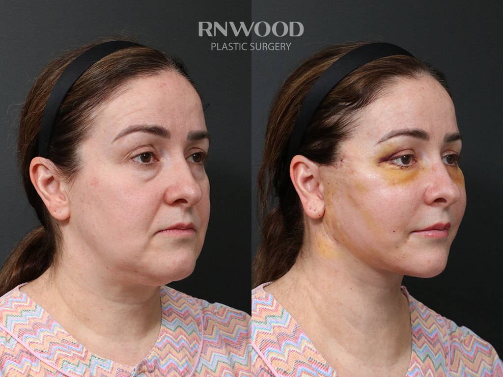 DEEP PLANE FACELIFT and Necklift, before and after, right three-quarter view, case 02