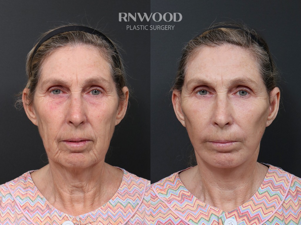 DEEP PLANE FACELIFT and Necklift, before and after, front view, case 03