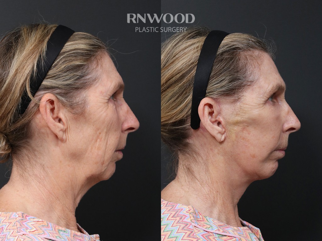 DEEP PLANE FACELIFT and Necklift, before and after, right profile view, case 03