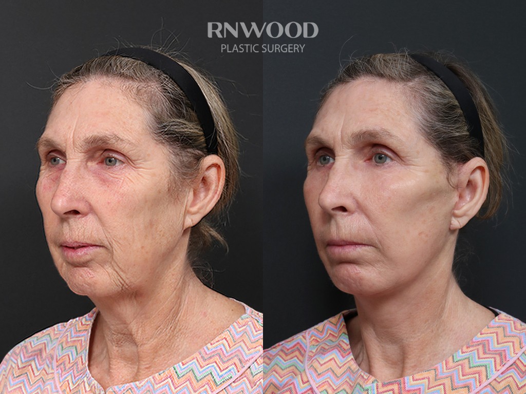 DEEP PLANE FACELIFT and Necklift, before and after, left three-quarter view, case 03
