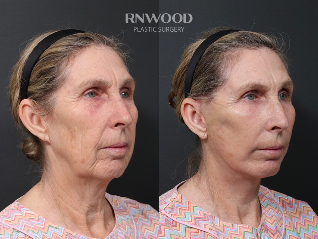 DEEP PLANE FACELIFT and Necklift, before and after, right three-quarter view, case 03