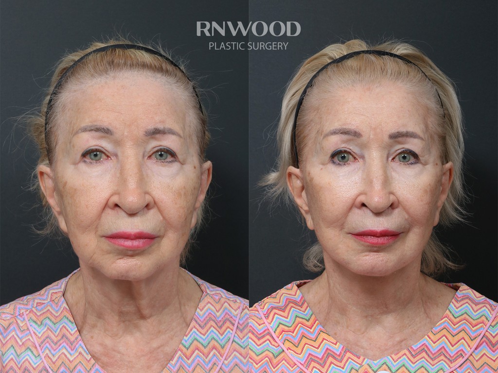 Revision DEEP PLANE FACELIFT and Necklift, before and after, front view, case 04