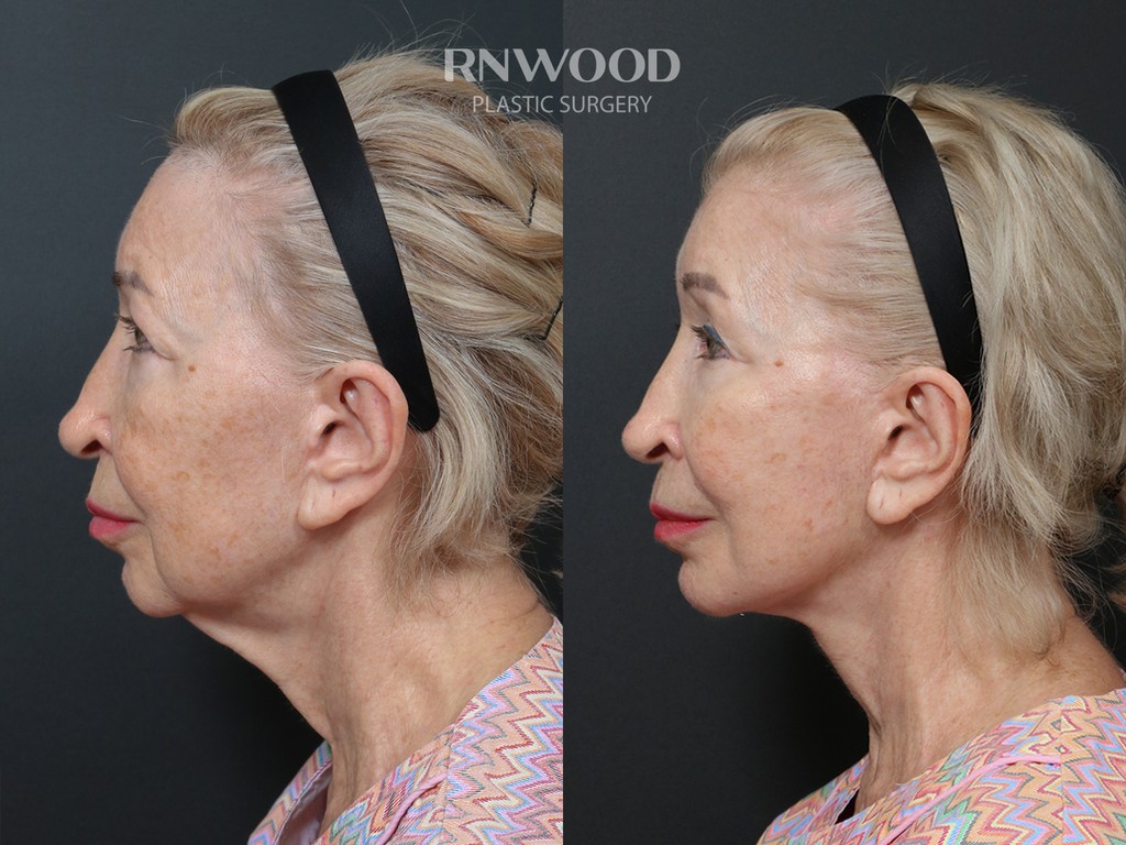 Revision DEEP PLANE FACELIFT and Necklift, before and after, left profile view, case 04
