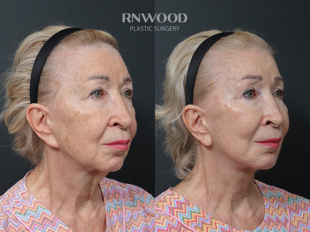 Revision DEEP PLANE FACELIFT and Necklift, before and after, right three-quarter view, case 04