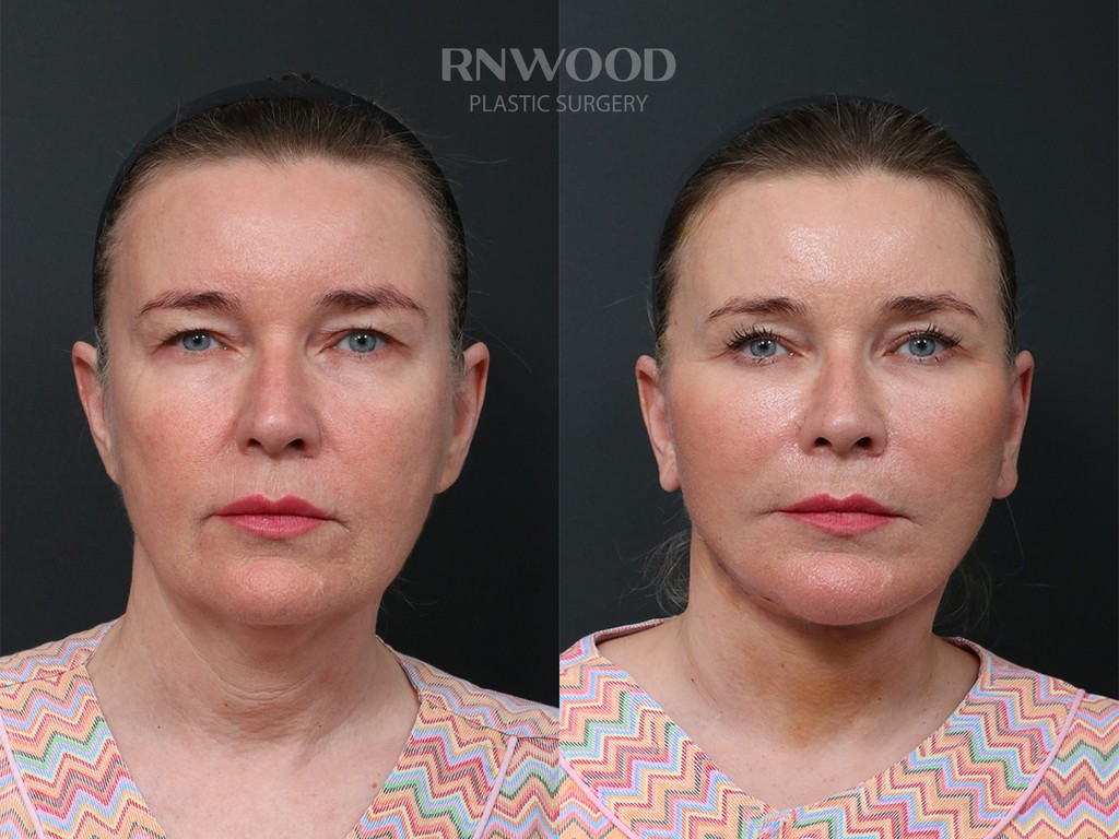 DEEP PLANE FACELIFT and Necklift, before and after, front view, case 05