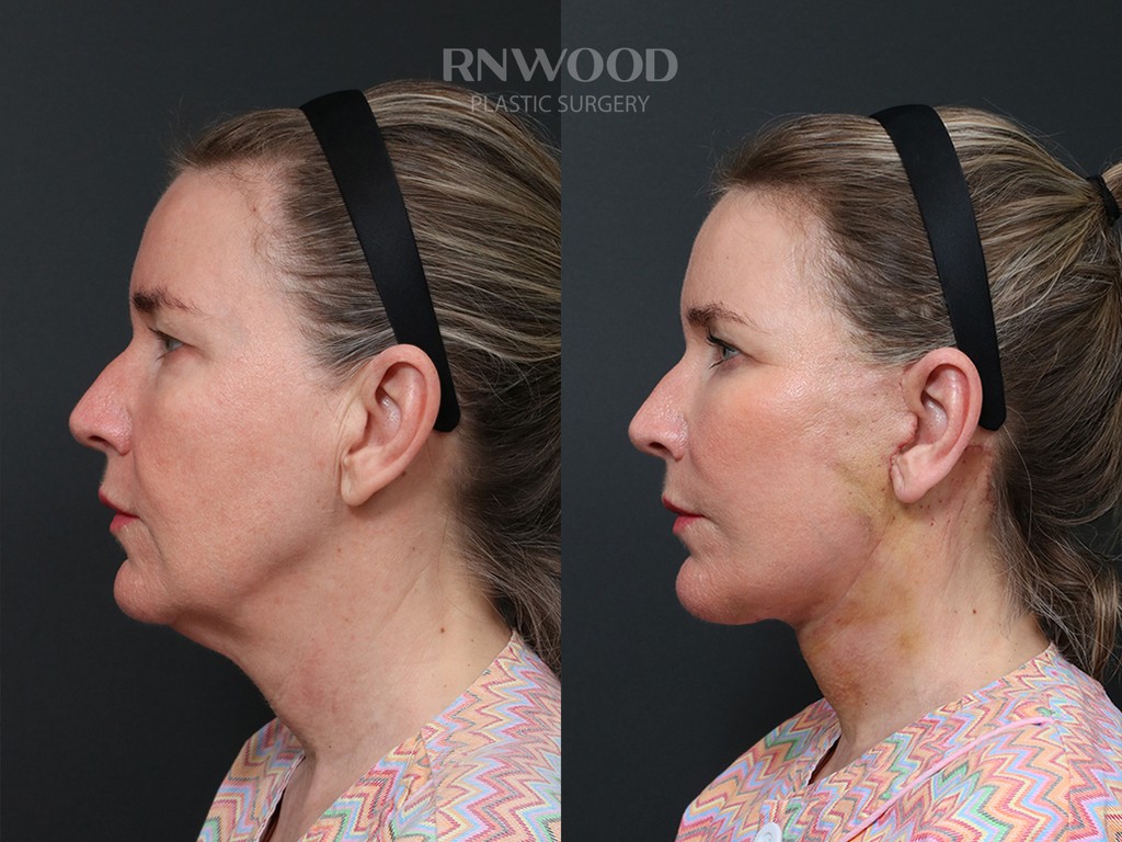 DEEP PLANE FACELIFT and Necklift, before and after, left profile view, case 05