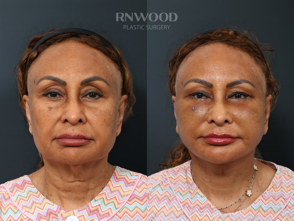 DEEP PLANE FACELIFT and Necklift, before and after, front view, case 06