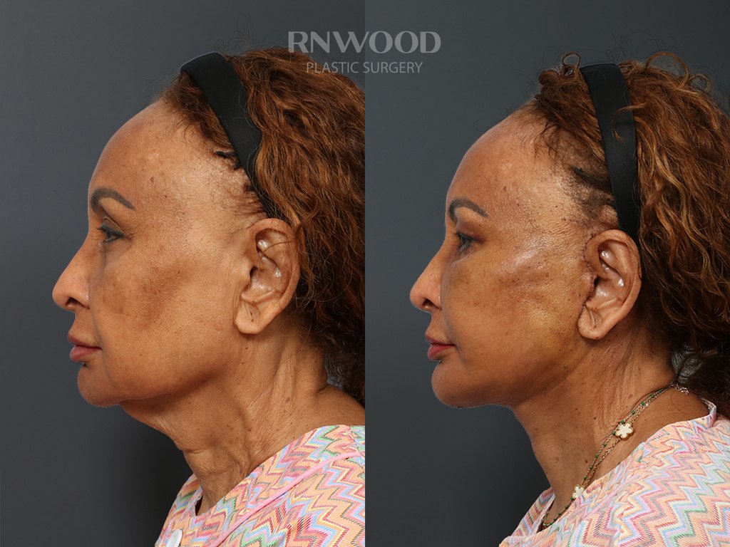DEEP PLANE FACELIFT and Necklift, before and after, left profile view, case 06