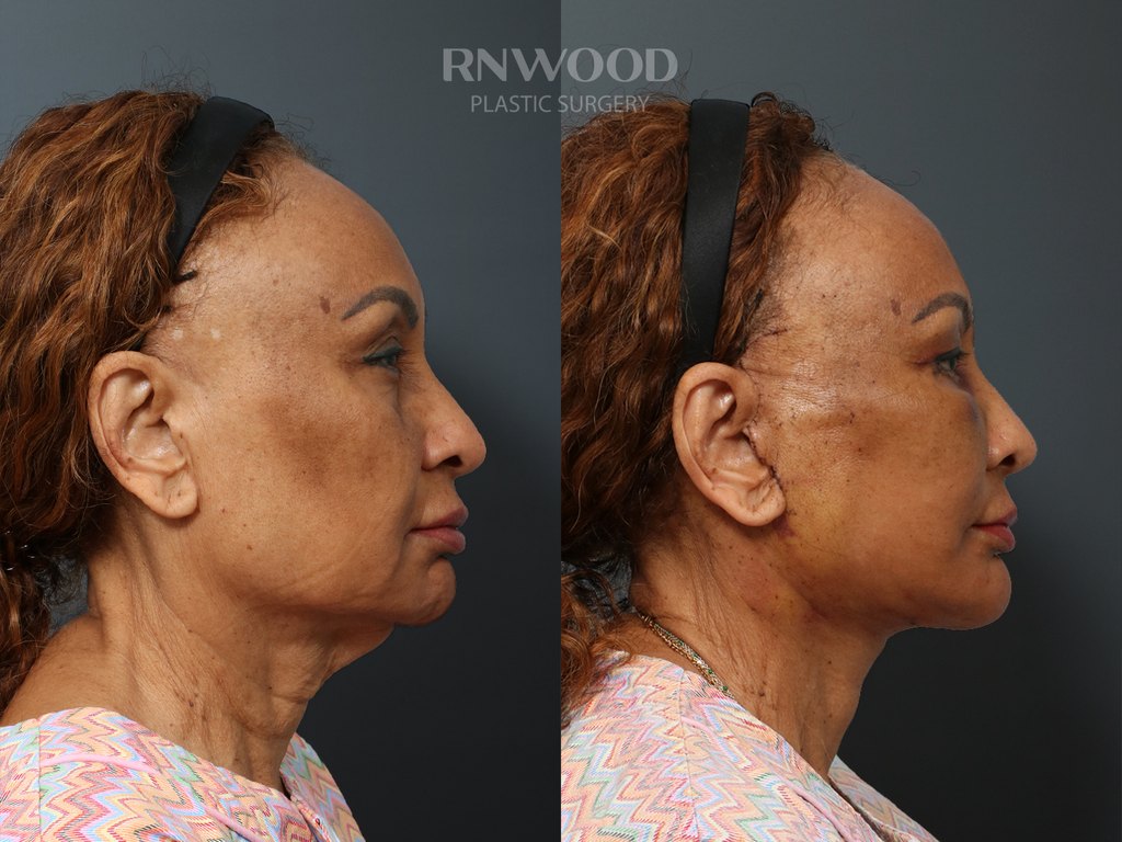 DEEP PLANE FACELIFT and Necklift, before and after, right profile view, case 06