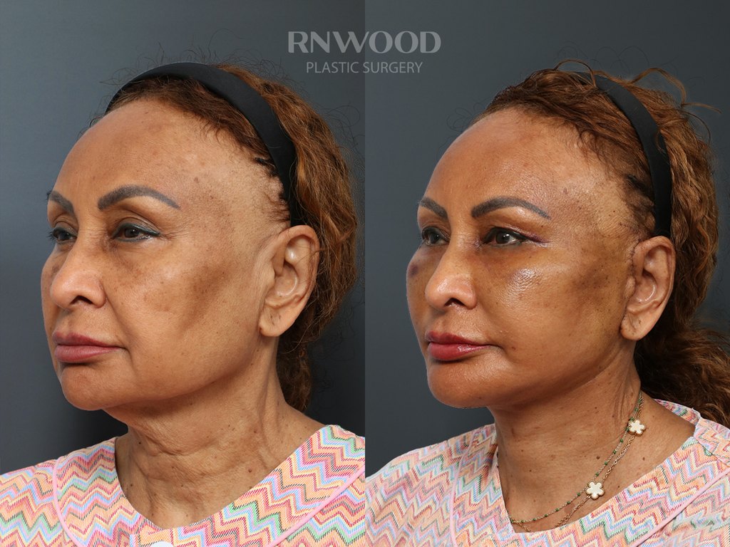 DEEP PLANE FACELIFT and Necklift, before and after, left three-quarter view, case 06