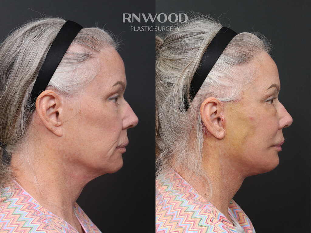 Revision DEEP PLANE FACELIFT and Necklift, before and after, right profile view, case 07