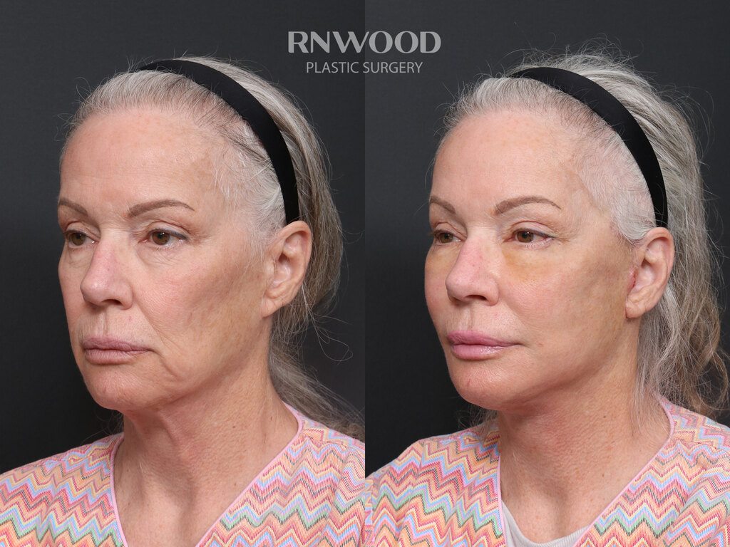 Revision DEEP PLANE FACELIFT and Necklift, before and after, left three-quarter view, case 07