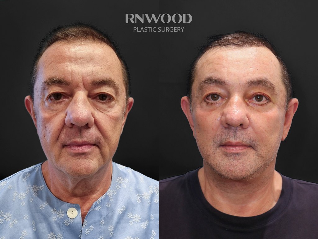 DEEP PLANE FACELIFT and Necklift, before and after, front view, case 08