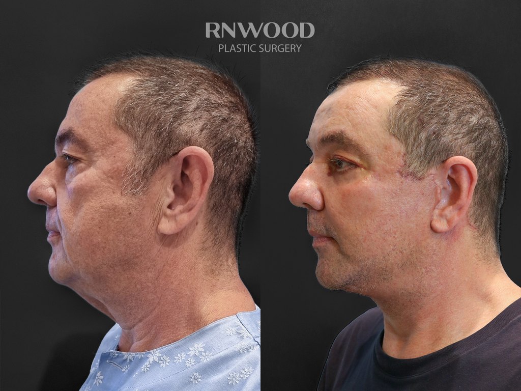 DEEP PLANE FACELIFT and Necklift, before and after, left profile view, case 08