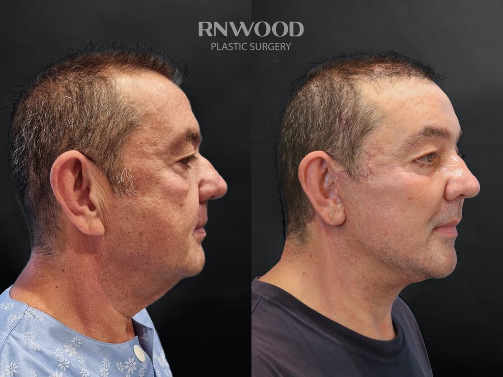 DEEP PLANE FACELIFT and Necklift, before and after, right profile view, case 08
