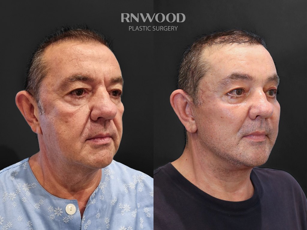 DEEP PLANE FACELIFT and Necklift, before and after, right three-quarter view, case 08