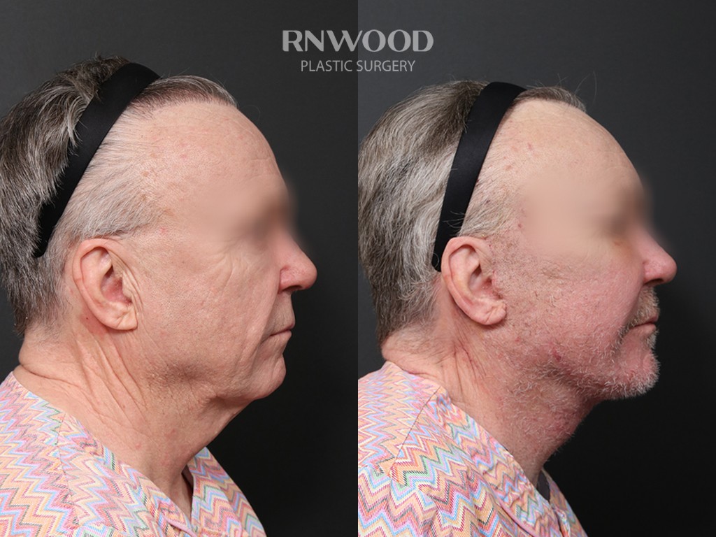 DEEP PLANE FACELIFT and Necklift, before and after, right profile view, case 09