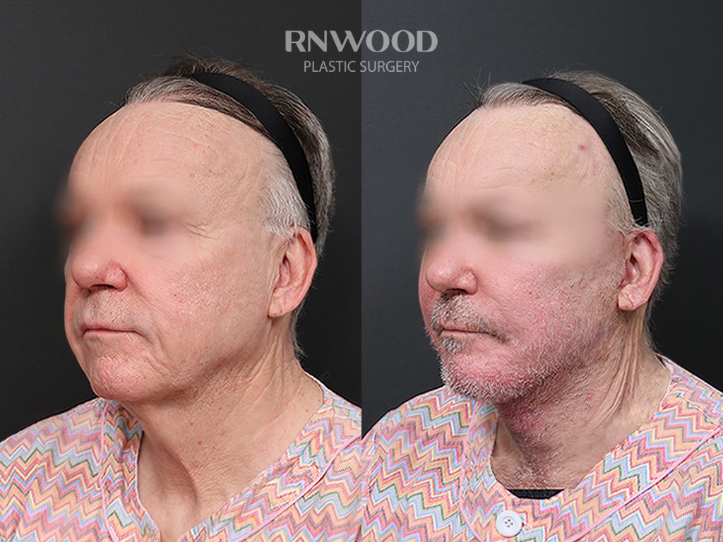 DEEP PLANE FACELIFT and Necklift, before and after, left three-quarter view, case 09