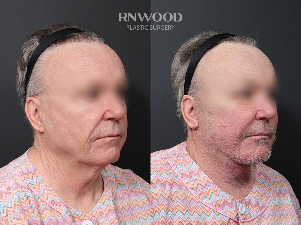 DEEP PLANE FACELIFT and Necklift, before and after, right three-quarter view, case 09