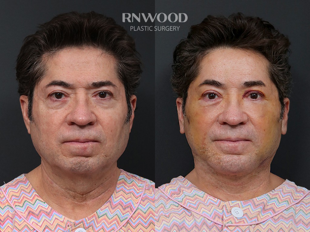 DEEP PLANE FACELIFT and Necklift, before and after, front view, case 10