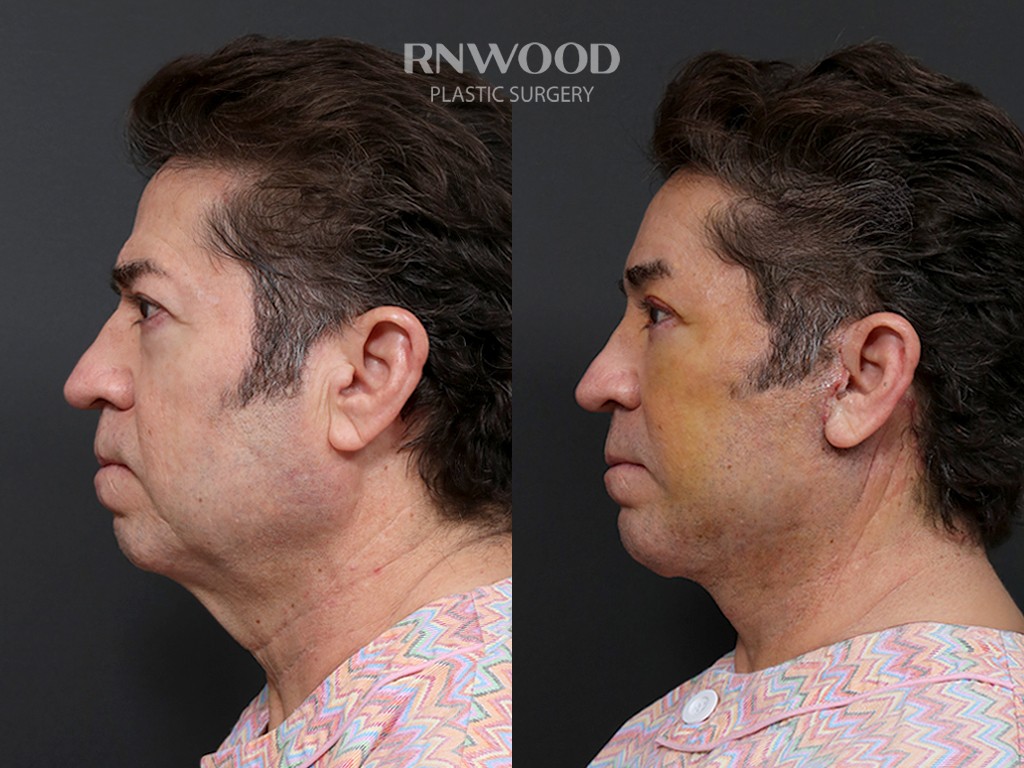 DEEP PLANE FACELIFT and Necklift, before and after, left profile view, case 10