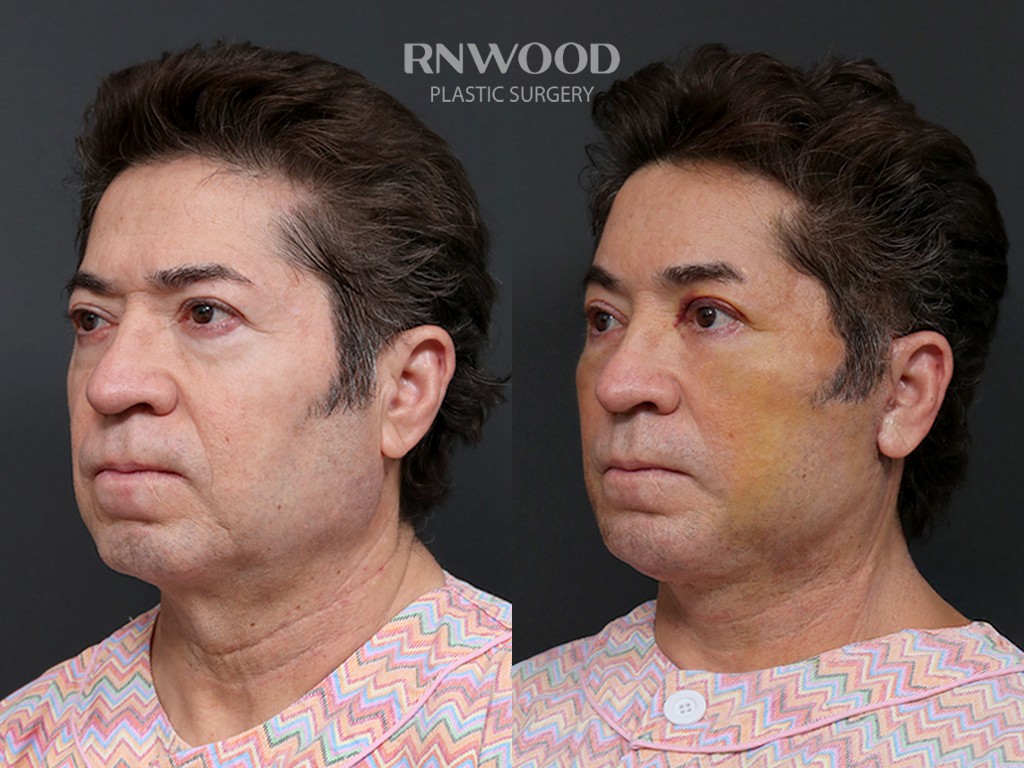 DEEP PLANE FACELIFT and Necklift, before and after, left three-quarter view, case 10