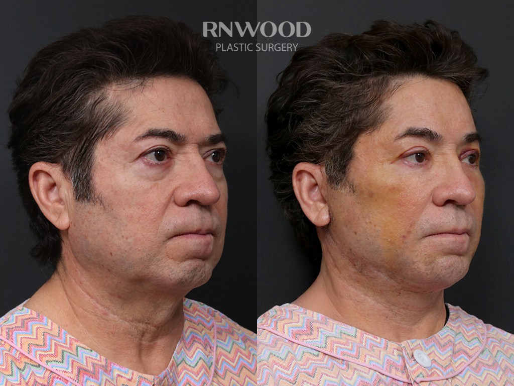 DEEP PLANE FACELIFT and Necklift, before and after, right three-quarter view, case 10