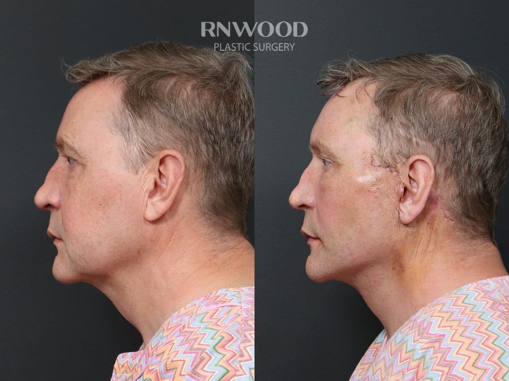 DEEP PLANE FACELIFT and Necklift, before and after, left profile view, case 11