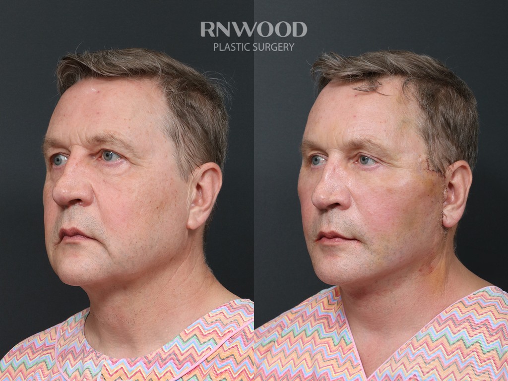 DEEP PLANE FACELIFT and Necklift, before and after, left three-quarter view, case 11
