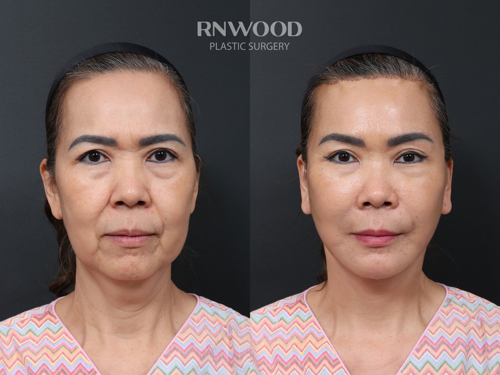 DEEP PLANE FACELIFT and Necklift, before and after, front view, case 12