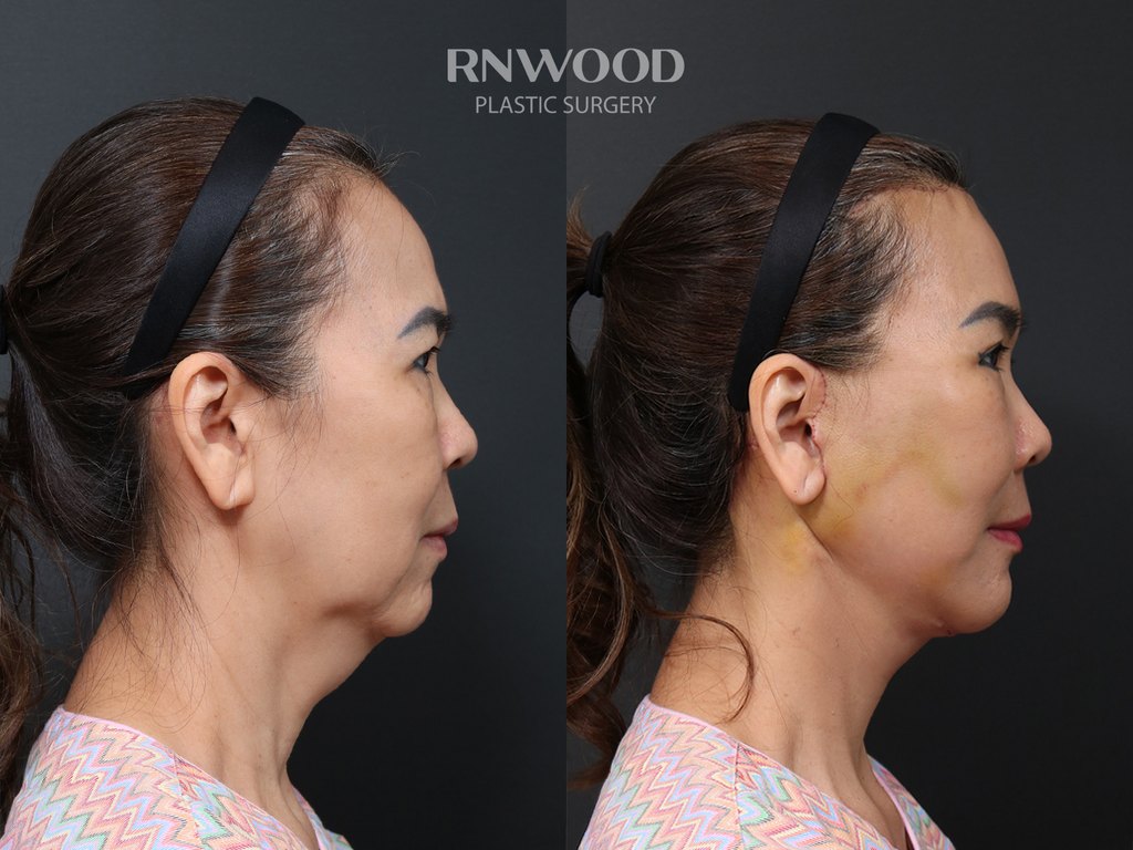 DEEP PLANE FACELIFT and Necklift, before and after, right profile view, case 12