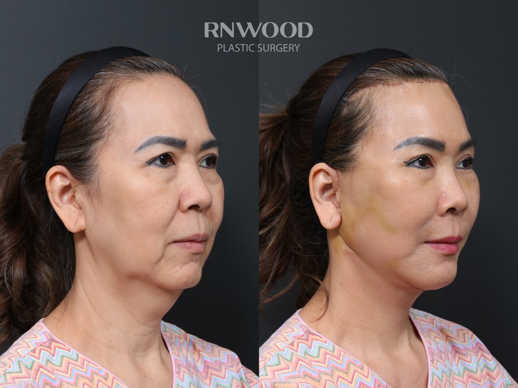 DEEP PLANE FACELIFT and Necklift, before and after, right three-quarter view, case 12