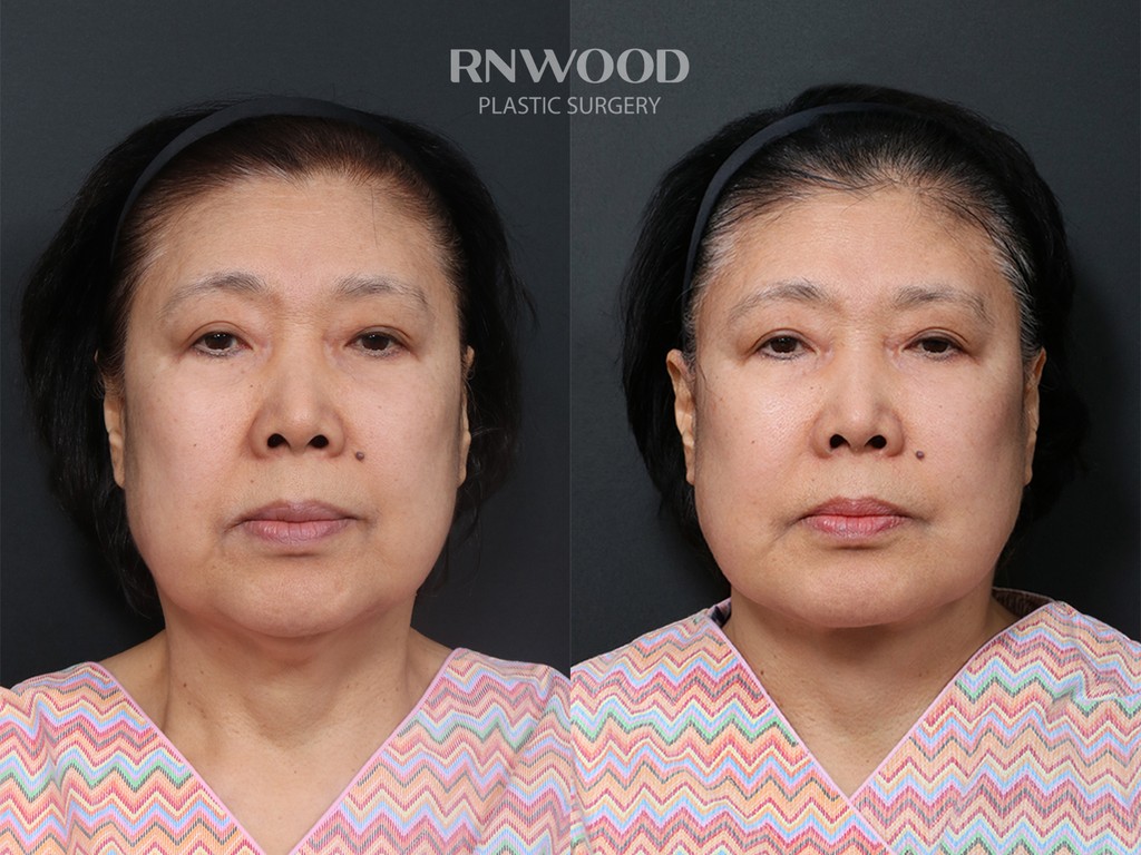 DEEP PLANE FACELIFT and Necklift, before and after, front view, case 13