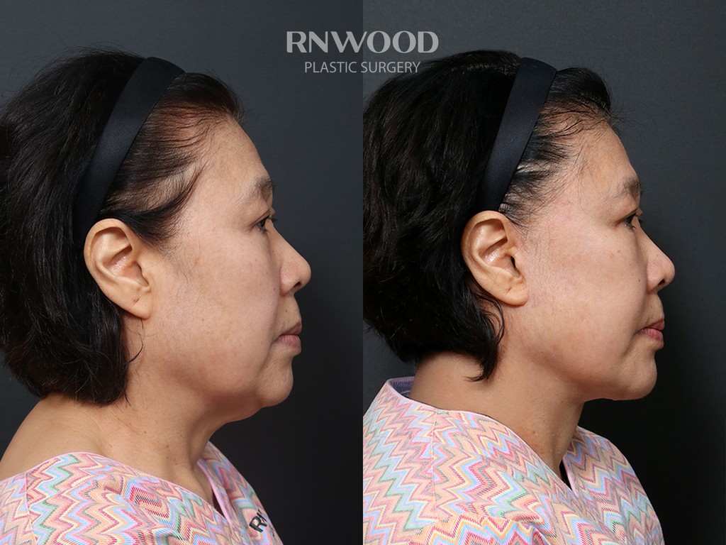 DEEP PLANE FACELIFT and Necklift, before and after, right profile view, case 13