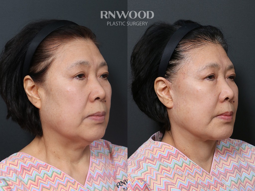 DEEP PLANE FACELIFT and Necklift, before and after, right three-quarter view, case 13