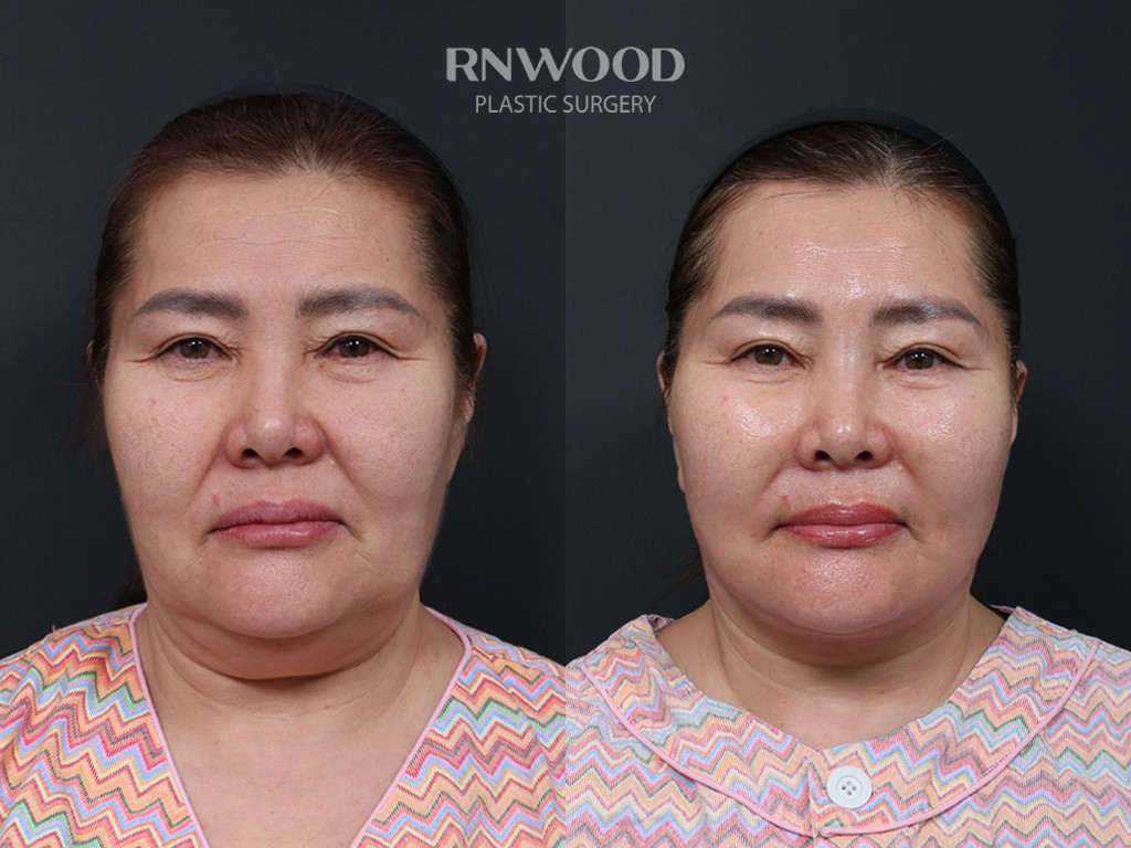DEEP PLANE FACELIFT and Necklift, before and after, front view, case 14