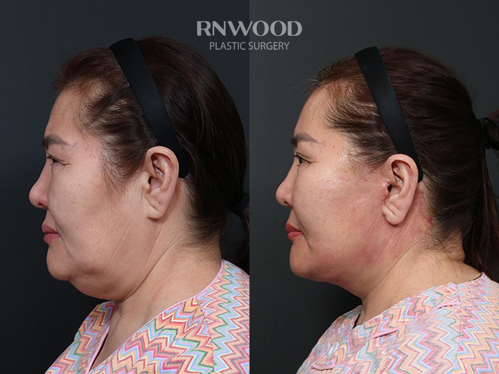 DEEP PLANE FACELIFT and Necklift, before and after, left profile view, case 14