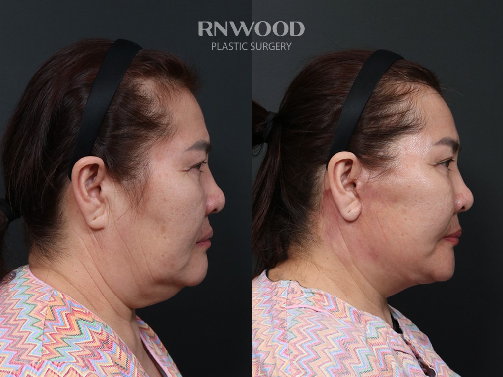 DEEP PLANE FACELIFT and Necklift, before and after, right profile view, case 14