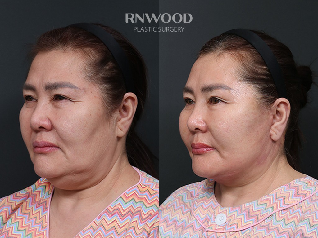 DEEP PLANE FACELIFT and Necklift, before and after, left three-quarter view, case 14