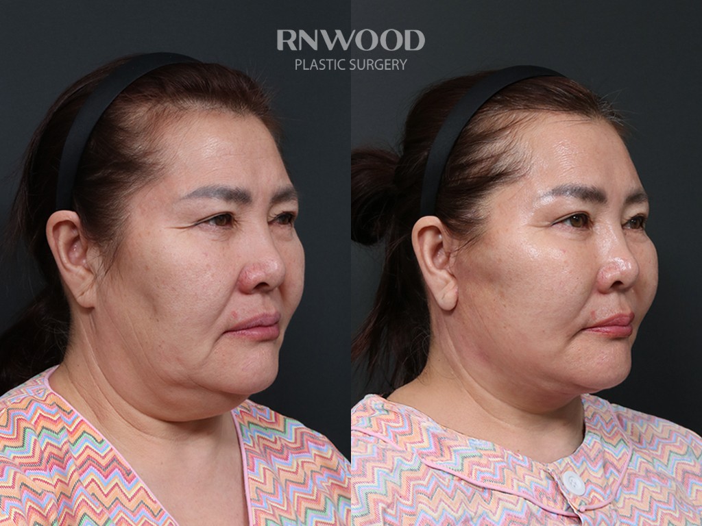 DEEP PLANE FACELIFT and Necklift, before and after, right three-quarter view, case 14